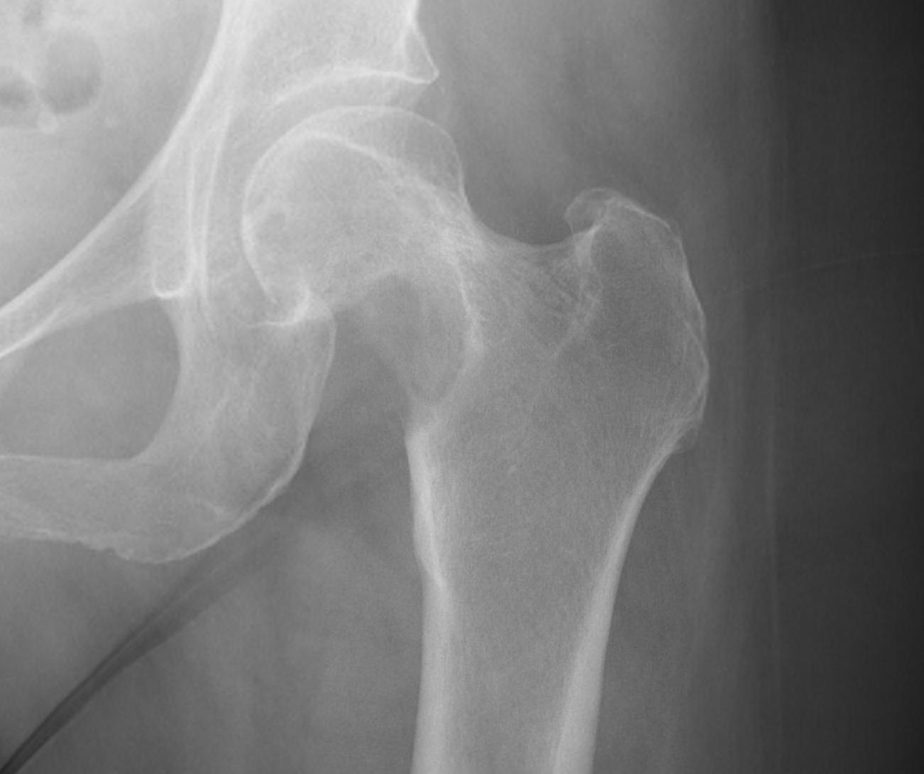 Proximal Femur Tumour